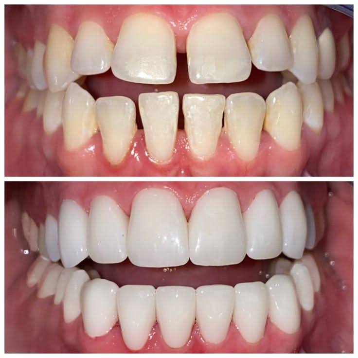 Teeth Reshaping product image