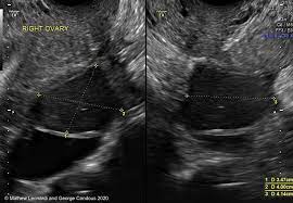 Nonvisualization of the ovaries on pelvic ultrasound: Noninvasive Ultrasound Diagnosis Of Endometriosis