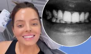 Composite bonding is a completely pain free procedure. Love Island S Maura Higgins Shows Off Her New White Teeth After Getting Braces To Widen Her Smile Daily Mail Online