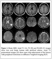 Image result for Brain Lesion