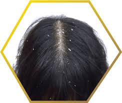 Dandruff itself does not cause hair loss. Dandruff Causes Treatment Jonsson Protein Sg