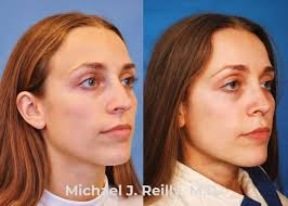 This lovely patient underwent a septoplasty and turbinate reduction with  another surgeon in March of 2021 but experienced no improvement of her  nasal obstruction from that surgery. She also presented with concerns