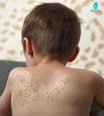 Image result for sweat rash on back baby