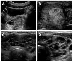 A pelvic ultrasound is a test that uses sound waves to make a picture of the inside of the lower belly (pelvis). Ultrasonography A Pelvic Ultrasound In A Girl Age Seven Years Showing Download Scientific Diagram