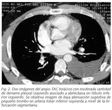 3 de mayo de 2009 a las :03. Una Causa Infrecuente De Tromboembolismo Pulmonar