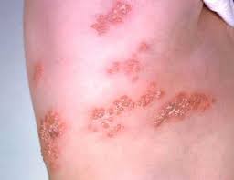Image result for shingles in children
