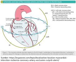 Depresi berat adalah gangguan mood. Kurniawan Prakoso On Twitter Lanjut Ya Untuk Cara Diagnosis Acs Pada Pasien Dengan Paced Rhythm Kurang Lebih Sama Kayak Lbbb Menggunakan Sgarbossa Criteria Untuk Isolated Posterior Mi Biasa Ditemukan Pada Pasien Dengan Total