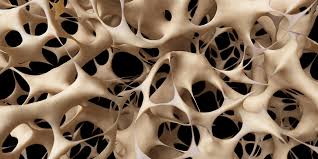 Osteoporosis