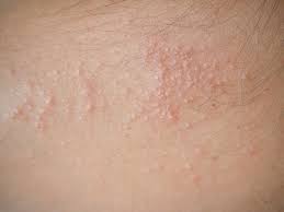 Often a raised red rash and sometimes hives. 7 Common Types Of Skin Rashes In The Philippines