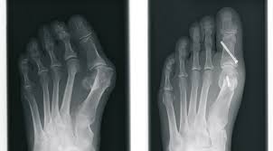 Der optimale operationszeitpunkt bei herzklappenerkrankungen. Orthopadisch Chirurgische Gemeinschaftspraxis Leistungsangebot Operative Leistungen Fussoperationen