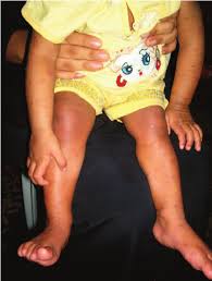 Image result for Papular urticaria