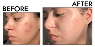 Image result for acne face
