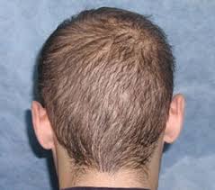 Itchy scalp isn't a direct cause of hair loss but can be a symptom of dandruff which can contribute to hair loss. Case 4 Diffusely Thin Hair