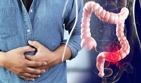 A low red blood cell count (anaemia or iron deficiency), which can cause tiredness and weakness. Bowel Cancer Major Symptoms And Signs Of The Disease Express Co Uk