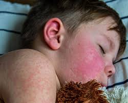 Image result for measles