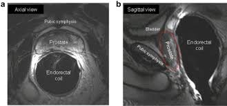 Anatomic Distortion With Endorectal Coil Magnetic Resonance Imaging Download Scientific Diagram