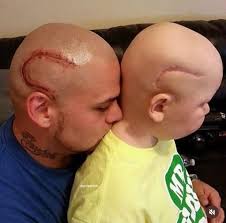 Dad gets same scar tattoo as son after brain cancer surgery