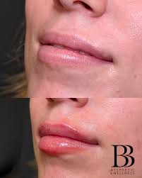 botox #bbaesthetic #daisies #justinbieber #instagram #ohio #cincinnati