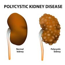 Medications included antibiotics in 100%, hydroxychloroquine in 96. Polycystic Kidney Disease Medlineplus Genetics