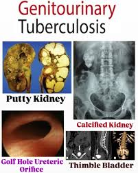 Image result for Genitourinary Tuberculosis