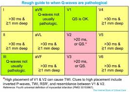 Image result for Q Wave