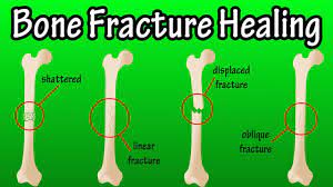 A fracture ankle occurs when one or more of the bones that comprise the ankle are broken. How Does A Bone Break Heal Bone Fracture Healing Process Youtube