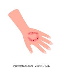 Image result for Human Bite