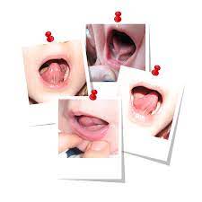 Epiglottis)‏ هو نسيج ضام غضروفي مرن مُغطَّى بغشاء مخاطي يغلق مدخل الحنجرة ويحميه أثناء عملية بلع الطعام، لكيلا يدخل الطعام إلى القصبة الهوائية، لذلك عندما يتكلم الإنسان أثناء تناول الطعام يضطر لسان المزمار. Autism Ø§Ù„ØªØµØ§Ù‚ Ø§Ù„Ù„Ø³Ø§Ù† Ø§Ù„Ù„Ø³Ø§Ù† Ø§Ù„Ù…Ø±Ø¨ÙˆØ· Ø§Ù„Ù„Ø³Ø§Ù† Ø§Ù„Ù…Ø±Ø¨ÙˆØ· Ø£Ùˆ Ø§Ù„ØªØµØ§Ù‚ Ø§Ù„Ù„Ø³Ø§Ù† Ù‡Ùˆ Ø­Ø§Ù„Ø© Ù…Ø±Ø¶ÙŠØ© ØªØ¸Ù‡Ø± Ù…Ù†Ø° Ø§Ù„ÙˆÙ„Ø§Ø¯Ø© ÙˆØª Ø¹ÙŠÙ‚ Ø­Ø±ÙƒØ© Ø§Ù„Ù„Ø³Ø§Ù† ØªØ¸Ù‡Ø± Ø­Ø§Ù„Ø© Ø§Ù„ØªØµØ§Ù‚ Ø§Ù„Ù„Ø³Ø§Ù† Ø¹Ù†Ø¯Ù…Ø§ ÙŠÙˆØ¬Ø¯ Ø´Ø±ÙŠØ· Ù†Ø³ÙŠØ¬ÙŠ Ù‚ØµÙŠØ± ÙˆÙ…Ø´Ø¯ÙˆØ¯ Ù„Ø¬Ø§Ù… Ù„Ø³Ø§Ù†ÙŠ