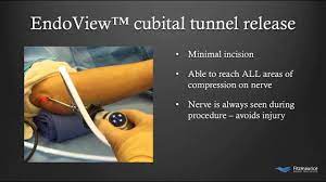 Cubital Tunnel Syndrome Fitzmaurice Hand Institute Scottsdale Fitz Hand