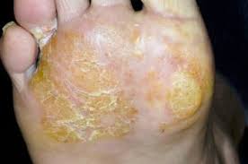 Eczema is a condition that causes inflamed, itchy, cracked, and rough skin. Hand Und Fussekzem Erkrankungen Der Haut Msd Manual Profi Ausgabe