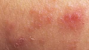 In a sentence if you wanted to say something about fungus you woud just say fungus. How To Get Rid Of An Armpit Rash