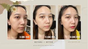 Karena benzoyl peroxide dan retinol adalah kandungan skincare yang tidak boleh dicampur, lebih disarankan untuk menggunakan kedua produk dengan kandungan benzoyl peroxide dan retinol di hari yang berbeda. Review Avoskin Miraculous Retinol Ampoule Im Piccha