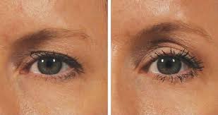 Last Van Hangende Oogleden Hangende Augenlider Hautbehandlungen Augenlid