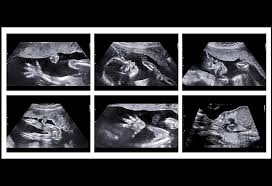 الأسبوع 20 من الحمل الأعراض حجم الجنين التغيرات في جسمك والمزيد