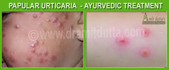 Image result for Papular urticaria