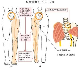 坐骨神経痛で症状が出やすい範囲（AI 生成）