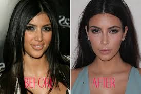Celebrity Nose Jobs Celebrity Noses Before And After Kardashian Plastic Surgery Nose Job Plastic Surgery