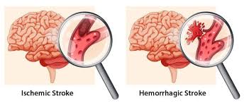 Right Hemisphere Stroke What Side Effects Can Occur Flint Rehab Stroke Recovery Stroke Treatment Stroke Rehabilitation