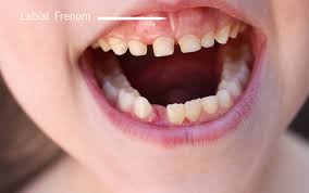 Frenectomy Dental Procedure For Children Dr Annabel Braganza 705 741 1885