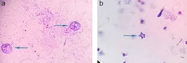 Acanthamoeba spp. in Dialysis Water: Assessing the Potential Risk of  Transmission to Hemodialysis Patients