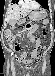 Image result for Necrotizing Enterocolitis