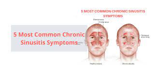 5 Most Common Chronic Sinusitis Symptoms Chronic Sinusitis Sinusitis Sinus Infection Symptoms