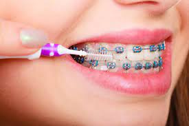 Braces can straighten teeth, line up your jaws to give you a better bite, space out crowded teeth, and close how do i take care of my teeth while they're on? Do Braces Straighten Teeth New And Improved Way