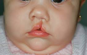 Normalmente, una cirugía del paladar hendido se hace entre los 9 y 18 meses de edad, y antes de los 2 años, debido a que es más complicada y puede causar más molestias que la cirugía de labio leporino. Lo Que No Sabias Del Labio Leporino Y El Paladar Hendido