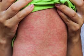 Hives from heat can also spread beyond the area initially affected. How To Treat Hives In Children And Common Causes Parents