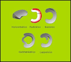 Meniskus Op Heilt Dein Meniskusriss Von Alleine Knie Marathon Knie Op Reha Patienten Aufgepasst