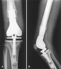 Environ 40 000/an prothèses du genou sont posées france. 10 Meilleures Idees Sur Prothese De Reprise Genou Prothese Prothese Genou Femur