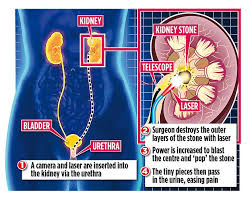 New High Tech Laser Can Blast Kidney Stones Into Dust During A Single Treatment Express Digest