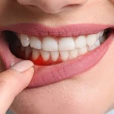 On average, people tend to develop them between the ages of 17 patient recovery varies, depending on each patient, how many wisdom teeth were removed and the degree of impaction. Wisdom Teeth Removal Coquitlam Bc Canada Vitacare Dental Centre