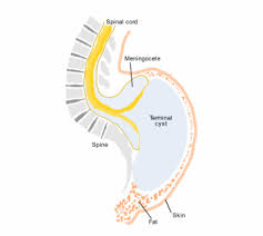 Image result for Dysraphism